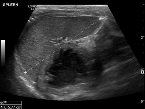 Normal Ultrasound Of The Spleen Maximum Longitudinal Length