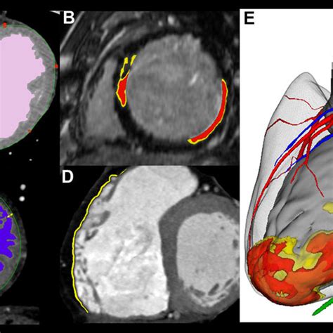 Image Processing Strategy A Imaging Is Used To Segment The Cardiac