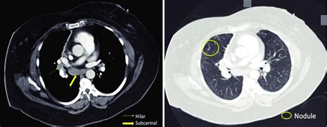 Patient S Ct Scan Of The Chest Revealing Hilar Lymphadenopathy