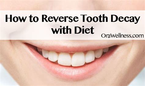 Tooth decay and cavities can be avoided, yet most of us have experienced many painful trips to the dentist. How to Reverse Tooth Decay with Diet - Simple Solutions