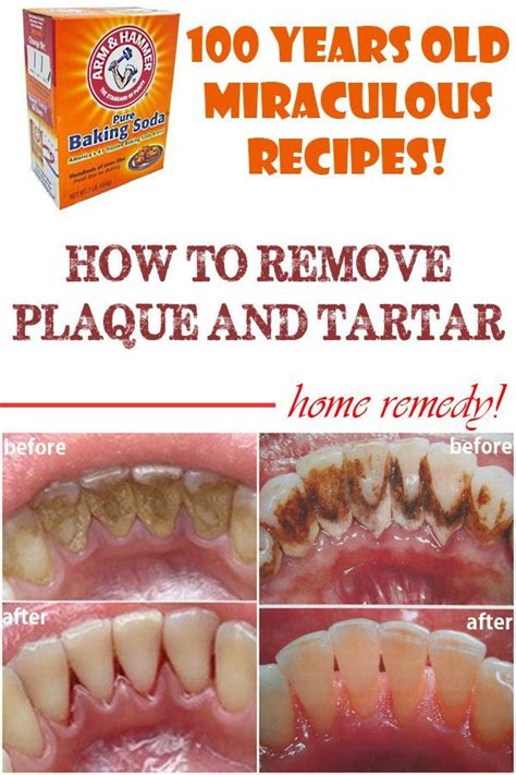how to remove very hard plaque from teeth howtoremvo