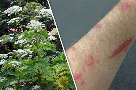 Giant Hogweed Leaves Man With Horror Blisters And Scars That Burn In