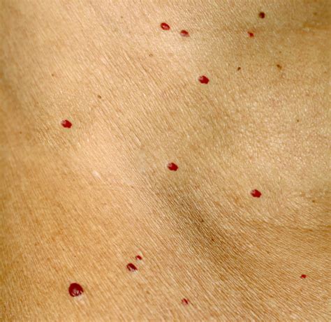 Little Red Spots On Skin