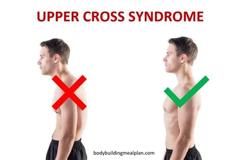 Upper Cross Syndrome Exercises To Correct Your Posture And Alleviate Pain