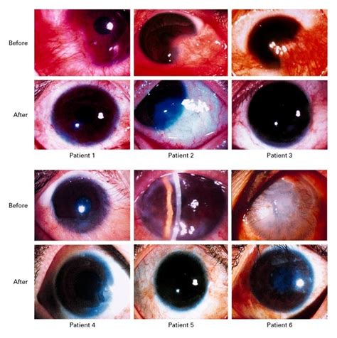 Reconstruction Of Damaged Corneas By Transplantation Of Autologous