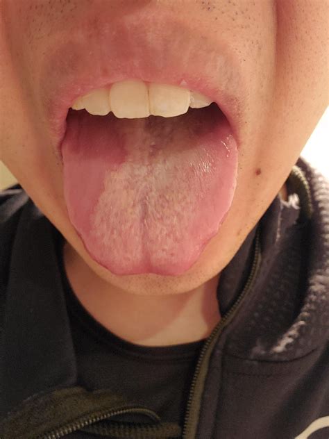Geographic Tongue Discussion Treatment And Community Dentistry