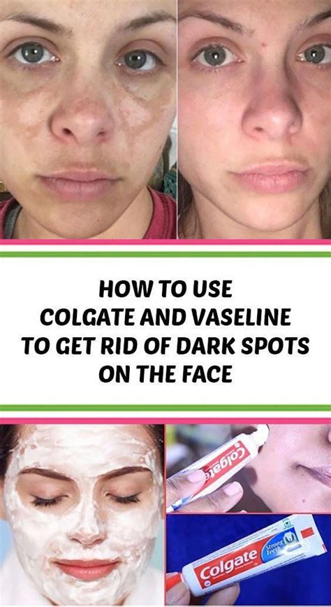 How To Use Colgate And Vaseline To Get Rid Of Dark Spots On The Face She Made By Grace
