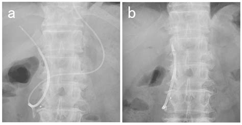 Cureus Feasibility Of Biliary Drainage Using A Novel Integrated