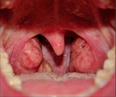 Ear Infection Acute Otitis Media Ent Clinic