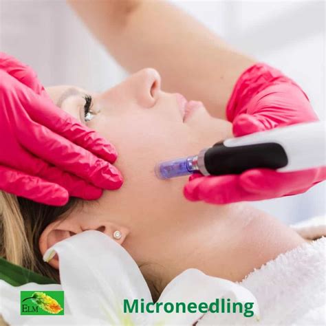 Microneedling Benefits 8 Reasons You May Want To Try It Elm Skin Clinics