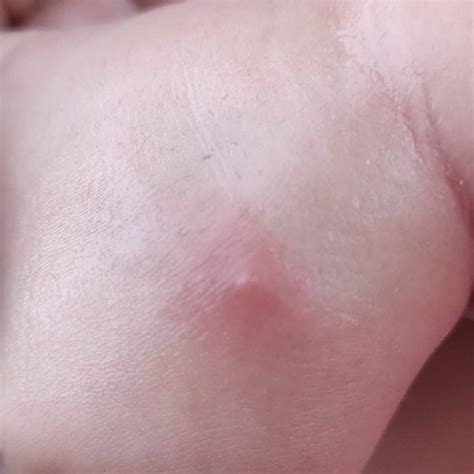 My 6th Month Old Daughter Develops Small Boils Or Pimples On Exposed