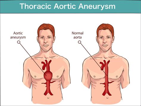Did You Know What A Thoracic Aortic Dissection Is Cardiac Surgery Online