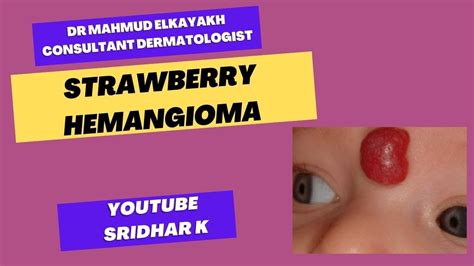 Strawberry Hemangioma Rash Newbornrash Strawberryhemangioma Youtube
