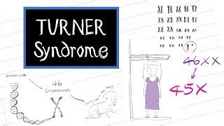 Chromosome Makeup Of Turner Syndrome Makeupview Co