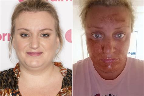 Actress Daisy May Cooper Begs For Help After Fake Tan Disaster And Its All Over Her Face