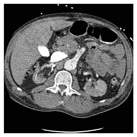 Preoperative Contrast Computed Tomography Scan Showing Involvement Of