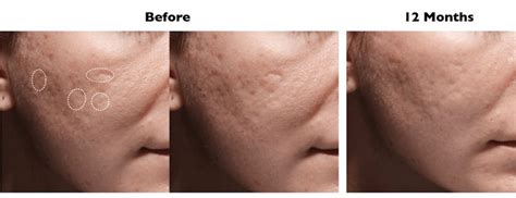 Acne Scars Treatment With Bellafill Sinus Sleep And Facial Plastic Surgery
