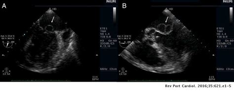 Mitral Valve Aneurysm A Serious Complication Of Aortic Valve
