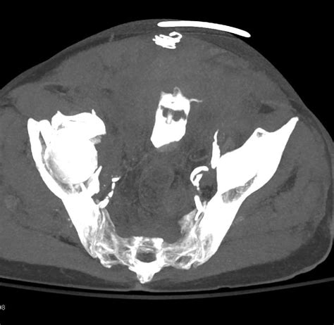 Complex Right Acetabular Fracture With Pelvic Bleed Musculoskeletal