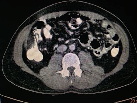 Most often laparoscopy for right iliac fossa pain is performed in women who may have gynecological conditions which can mimic appendicitis. Image IQ: 45 y/o, Pain in Right Iliac Fossa | Diagnostic ...
