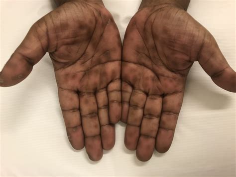 A Woman With A Rash On Her Palms And Soles Consultant360