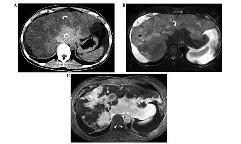 Typical Ct And Mri Signs Of Hepatic Epithelioid Hemangioendothelioma