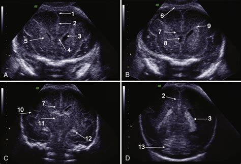 Prenatal Diagnosis Of Structural Brain Anomalies Neupsy Key