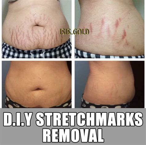 Stretch Marks Before And After