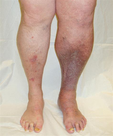 Blood Clots In Leg Medical Pictures Info Health Definitions Photos
