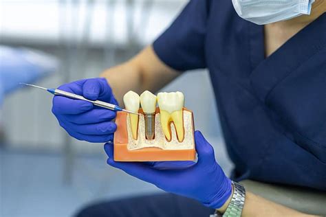 Dental Implants Vs Crowns East Valley Dental Professionals