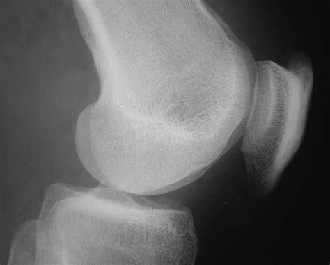 Rupture Of The Quadriceps Tendon Bone Joint