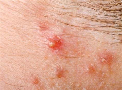 Types Of Scalp Folliculitis Ways To Get Rid Of Them Skinkraft Vlr