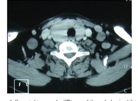 Figure 1 From Fluid Biopsy For Circulating Tumor Cells In An Occult