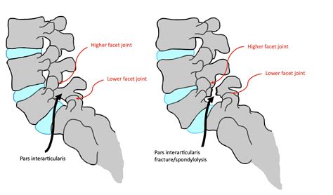 Pars Interarticularis Defect Injury • Peak Physio