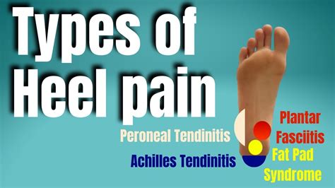Types Of Heel Pain San Diego Sports Chiropractic Youtube