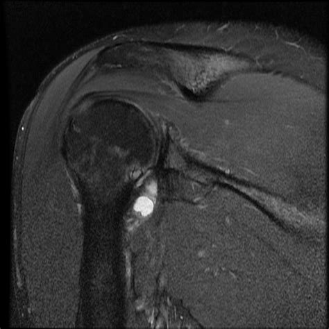 Paralabral Cyst Of The Shoulder With Quadrangular Space Syndrome