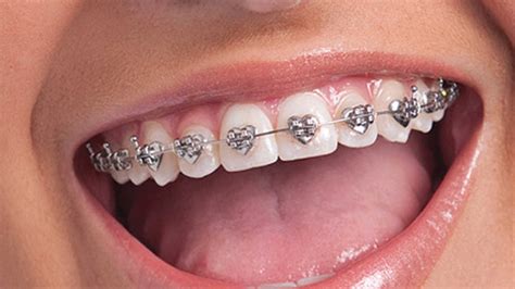 Make Your Childs Orthodontic Treatment Fun With Wildsmiles Braces