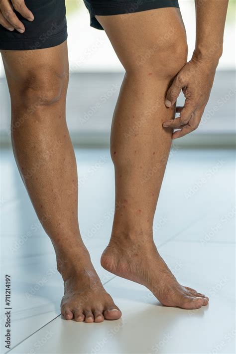 Midge Bite Marks On A Male Legs Feet And Legs Of A Man With Midge Bites Bitten By Hundreds Of