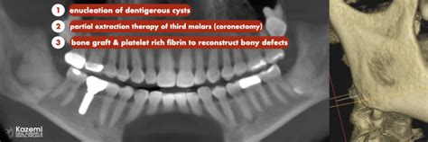 Removal Of Lower Jaw Dentigerous Cysts And Partial Extraction Therapy