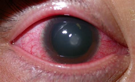Corneal Infection Ulcer Keratitis Eye Surgery Ltd
