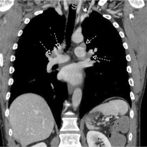Computed Tomography Ct Of The Chest Showing Bilateral Hilar