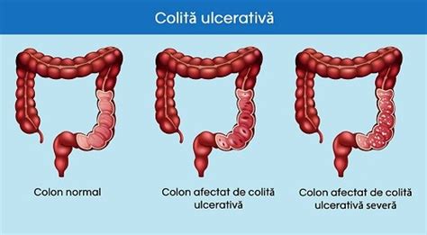 Colita Ulcerativa Cauze Simptome Tratament Hot Sex Picture
