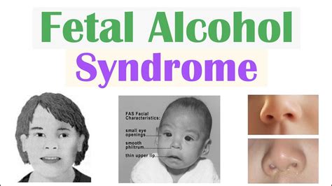 Fetal Alcohol Syndrome Fas Risk Factors Pathophysiology Signs