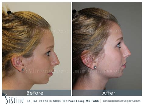 Nose Before And After 21 Sistine Facial Plastic Surgery
