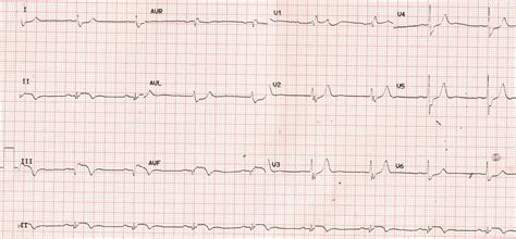 Evolved Inferior Wall Myocardial Infarction Ecg All About