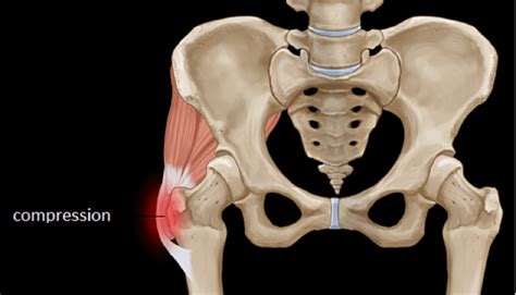 Hip Pain Gluteal Tendinopathy Head Toe Physio