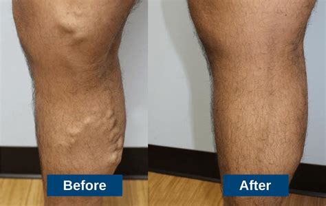 Guide To Varicose Vein Treatments And Which Works Best For You
