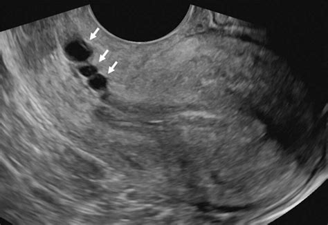 Tvus Images Demonstrate Incidental Benign Nabothian Cysts Arrows And