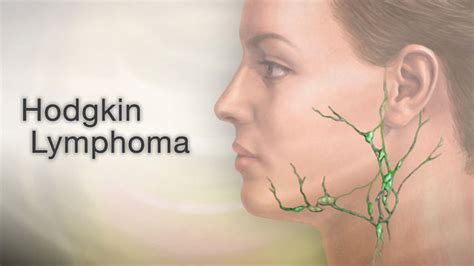 Hodgkin Lymphoma Did You Ever Touch Your Neck And Feel A Bump On One Or