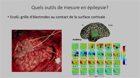 Chirurgie De Lépilepsie Et Interface Cerveau Machine Youtube